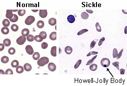 Sickle cell anaemia images