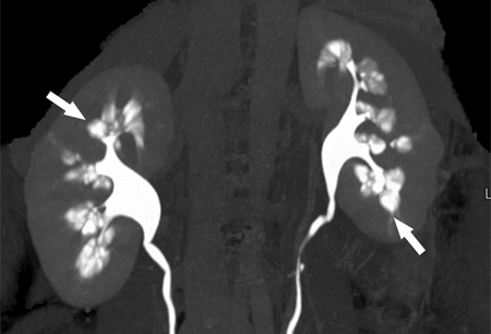 Medullary sponge kidney images