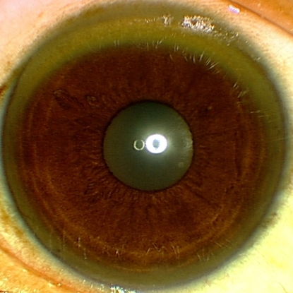 Evaluation of liver dysfunction images