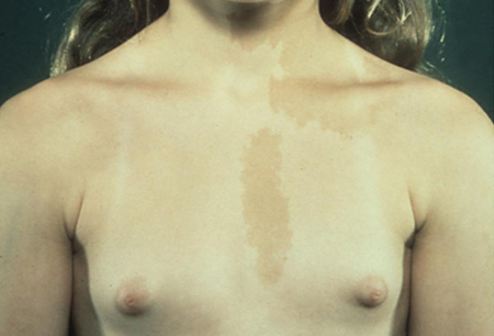 Precocious puberty images