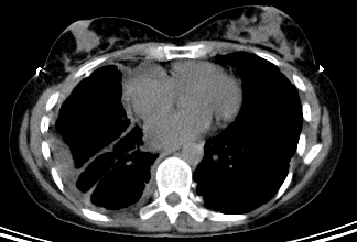 Mesothelioma images