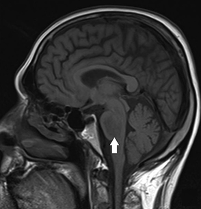 Hyponatraemia images