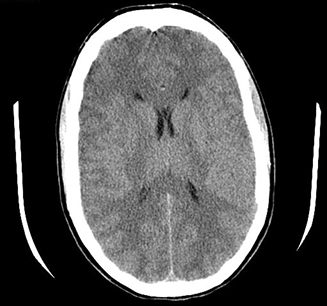 Hypernatraemia images