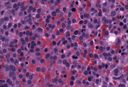 Multiple myeloma images