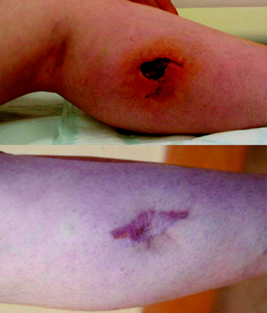 Animal bites images