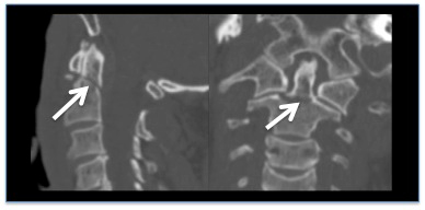 Acute cervical spine trauma in adults images