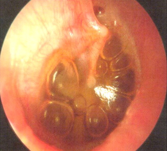 Otitis media with effusion images