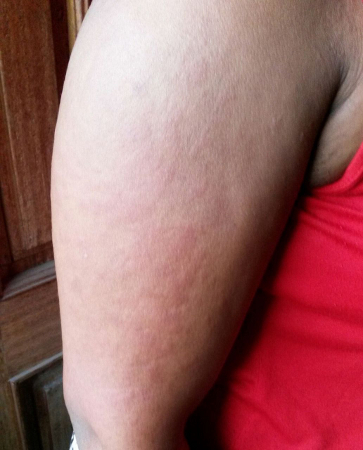 Adult-onset Still's disease images
