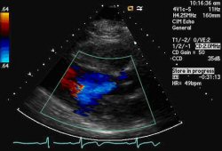 Aortic regurgitation images