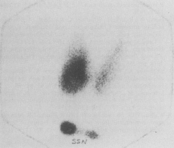 Toxic thyroid adenoma images
