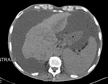 Assessment of ascites images