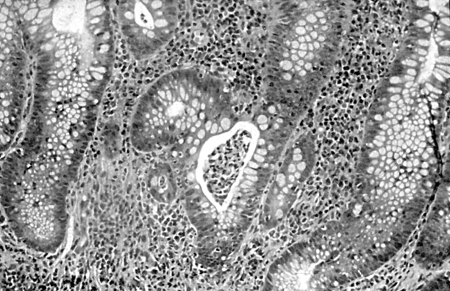 Ulcerative colitis images