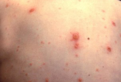 Acute varicella-zoster images