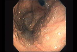 Familial adenomatous polyposis images