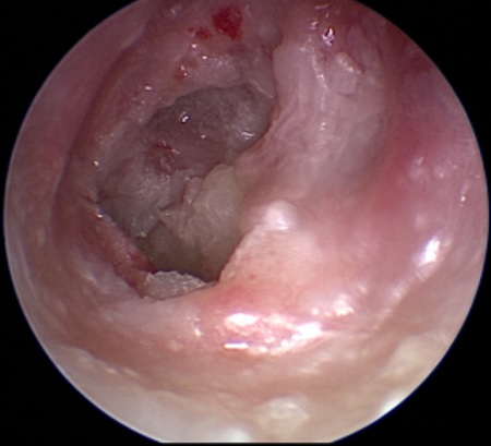 Labyrinthitis images