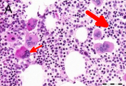 Essential thrombocythaemia images
