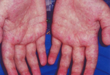Graft-versus-host disease images